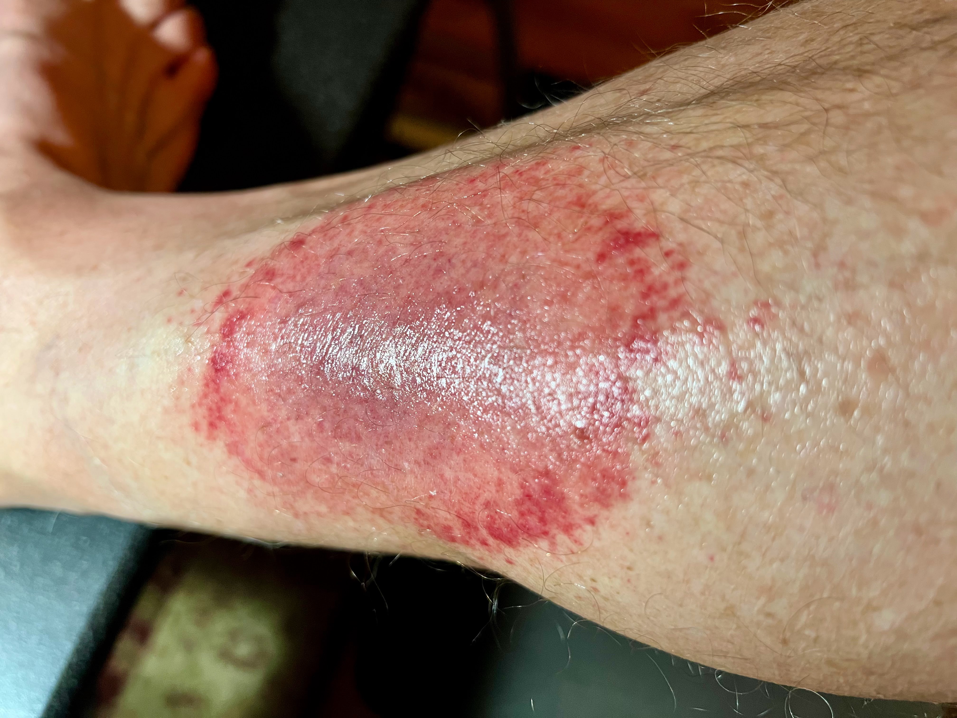 wednesday night red rash with ointment