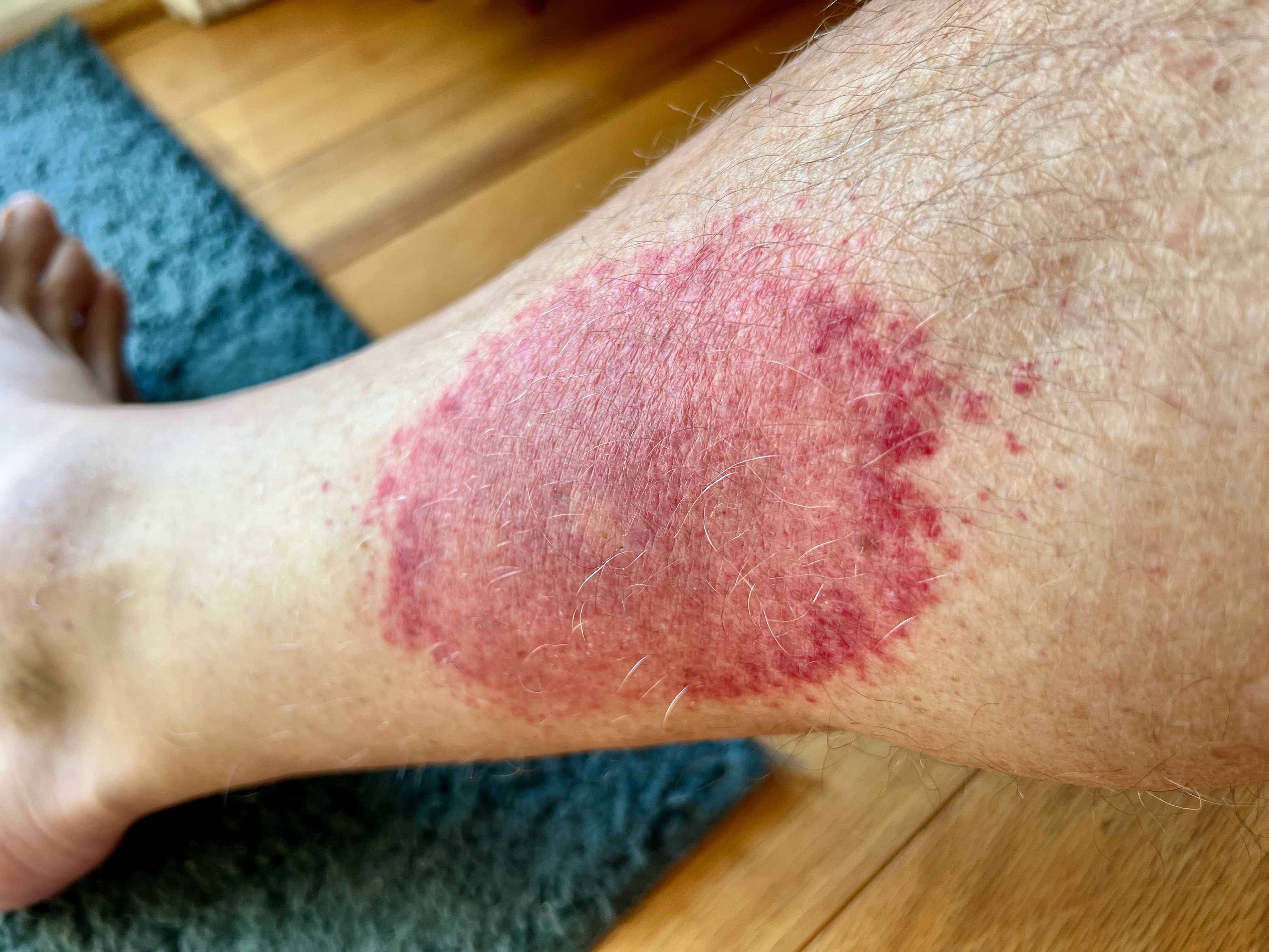 wednesday morning red rash