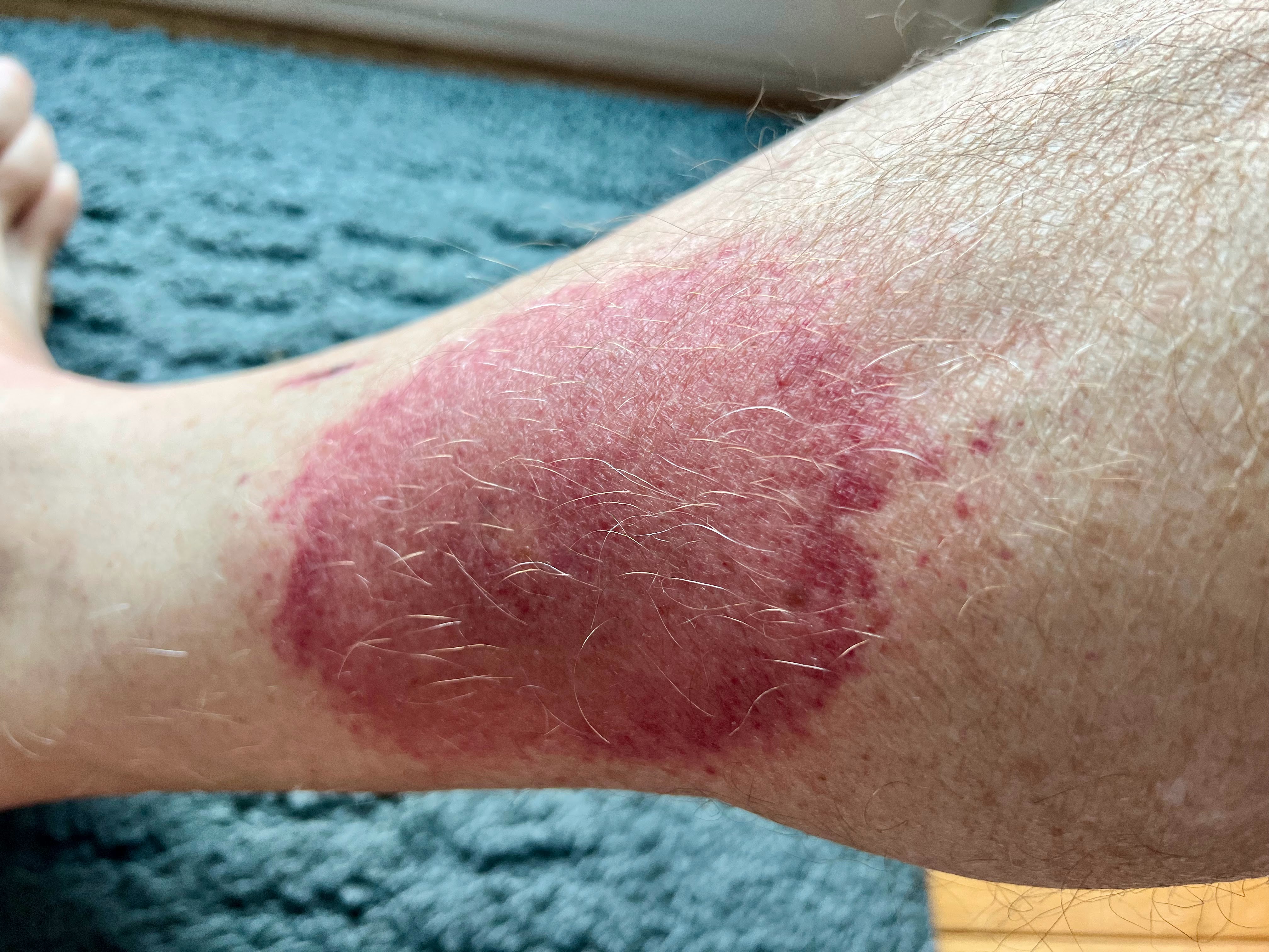 thursday morning red rash