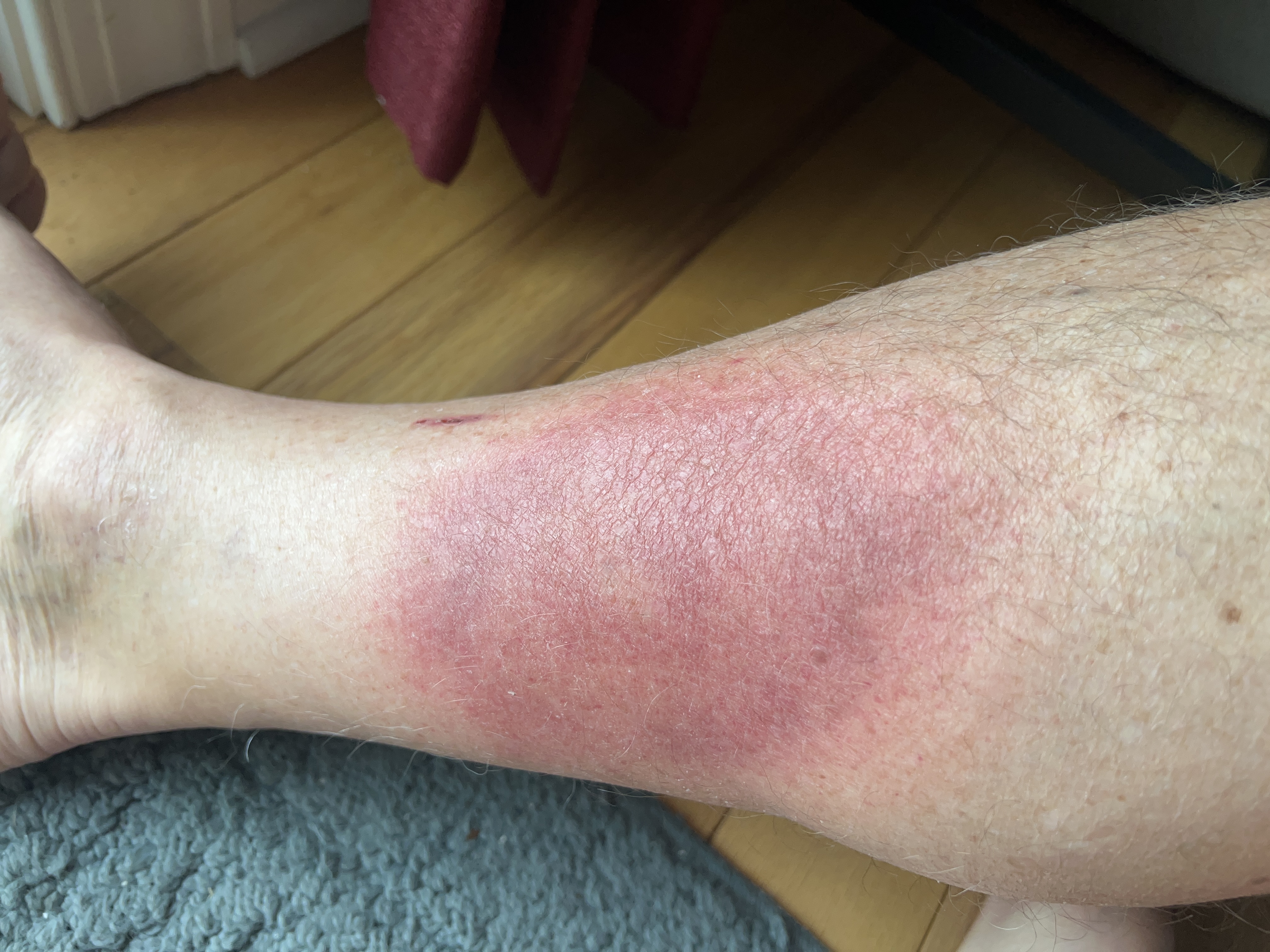 saturday morning red rash 24 hours after beginning doxy