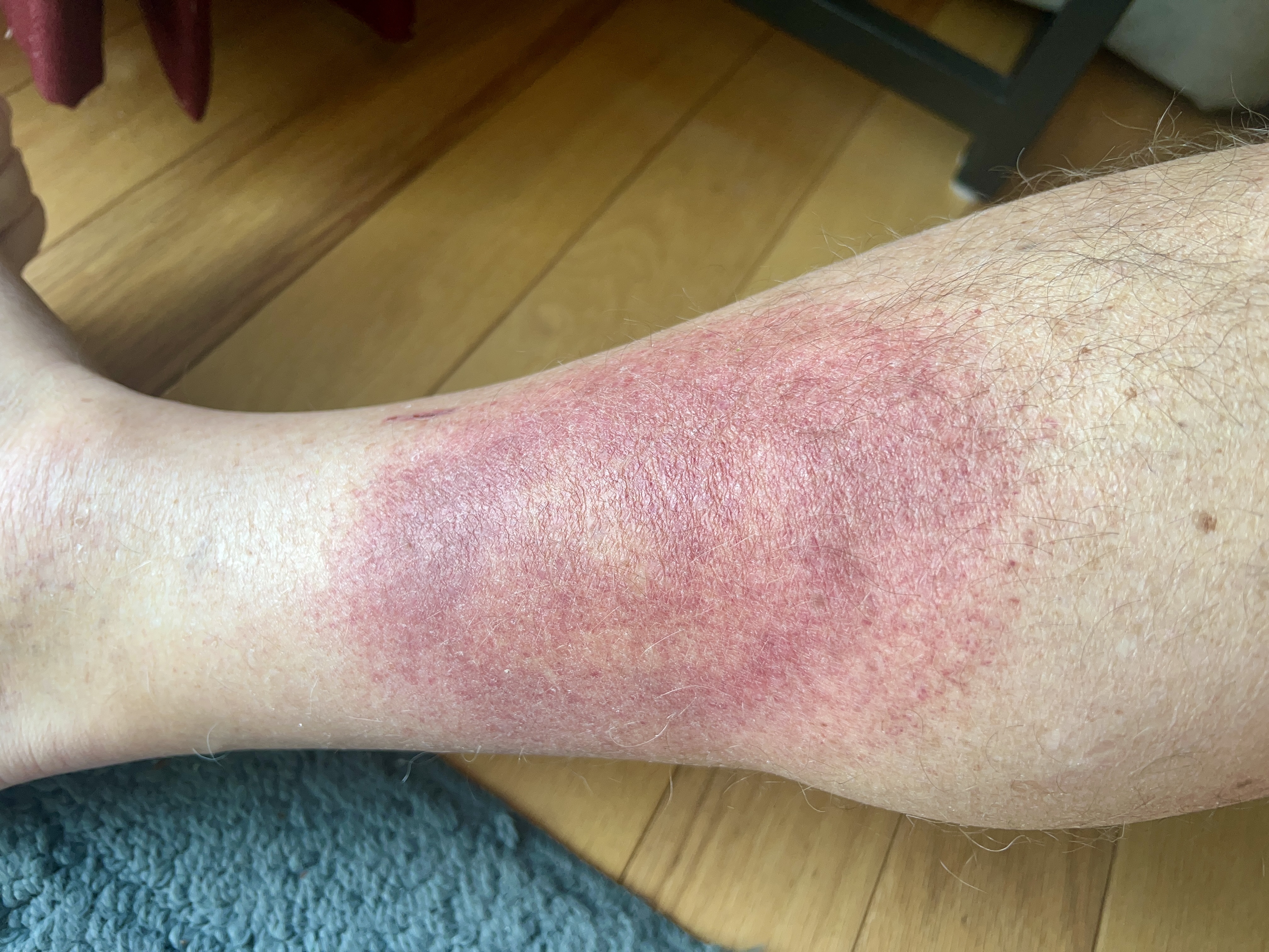 sunday morning red rash | 48 hours on doxy