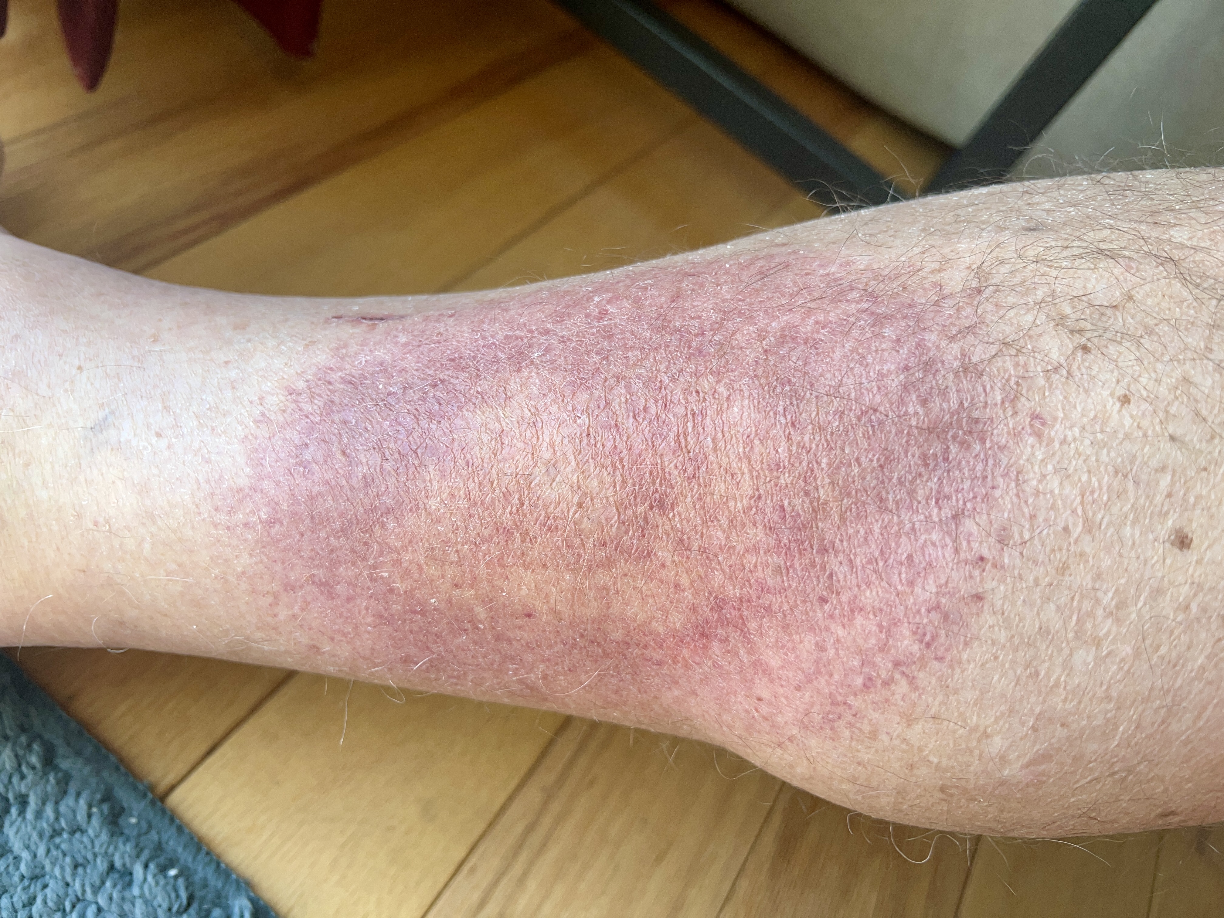 monday morning red rash | 72 hours on doxy