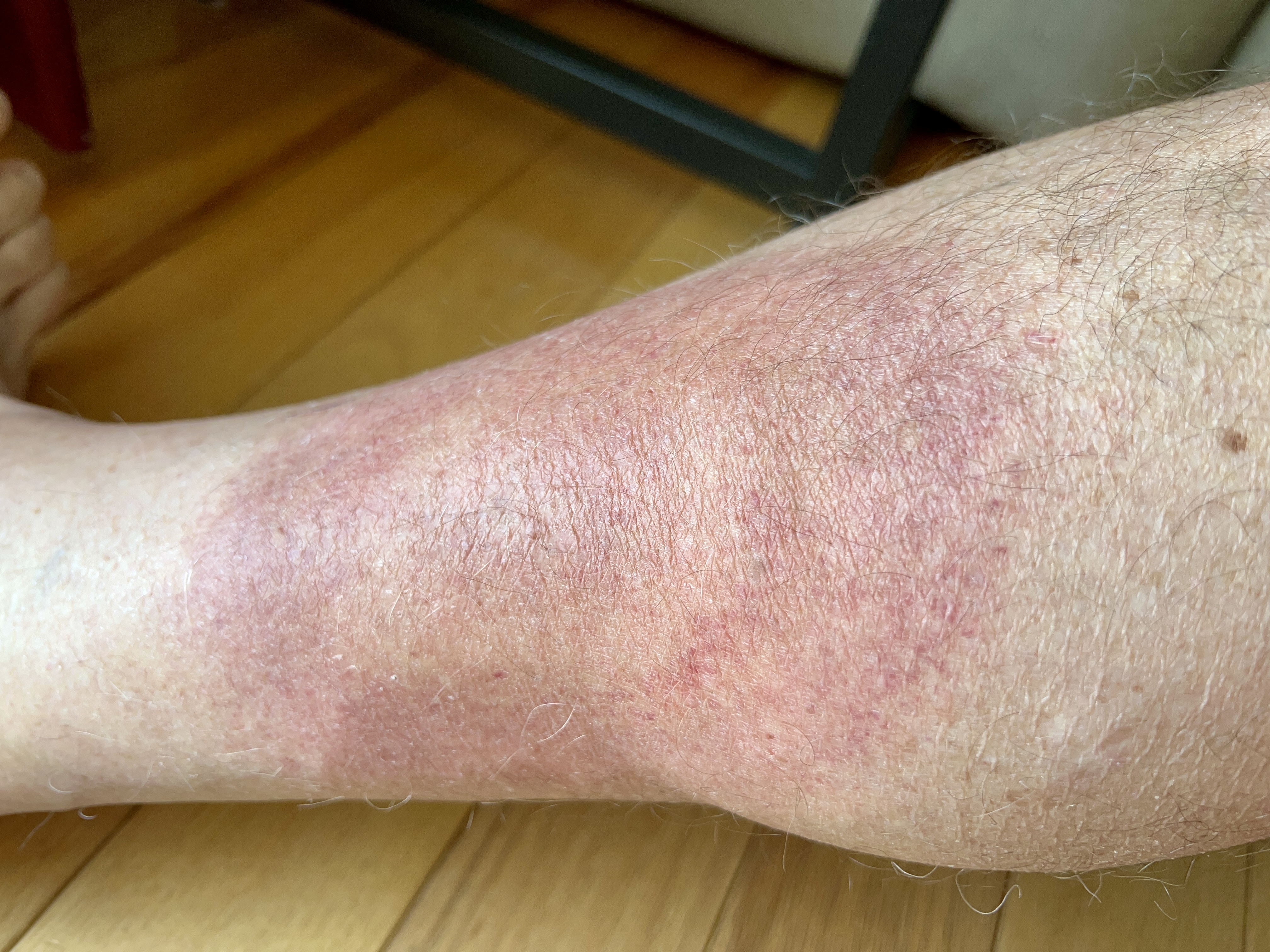 tuesday morning red rash | 4 days on doxy