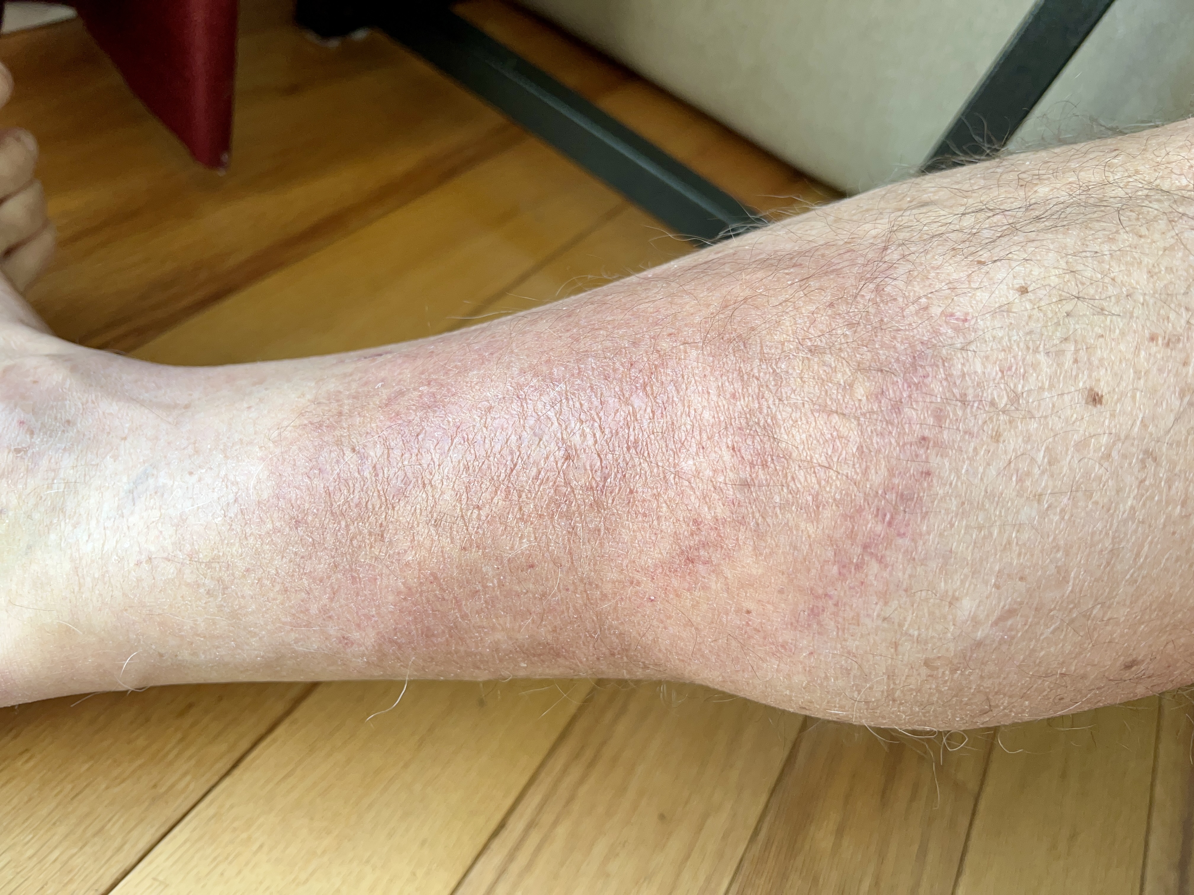 wednesday morning red rash | 5 days on doxy